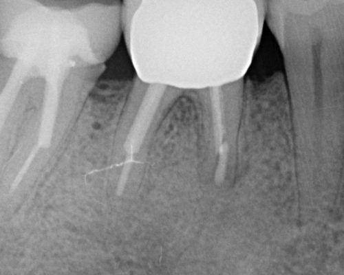 kindtand med heling efter rodspidsoperation