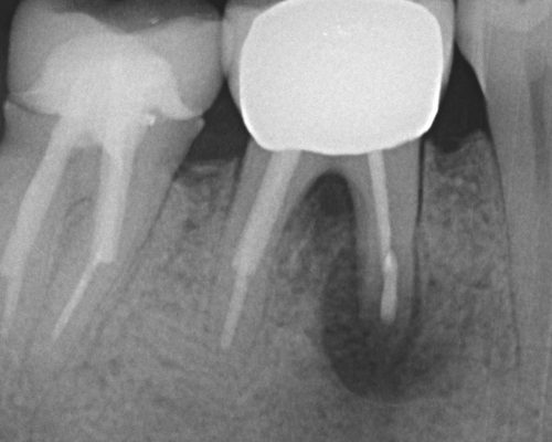 kindtand lige efter roidspidsoperation